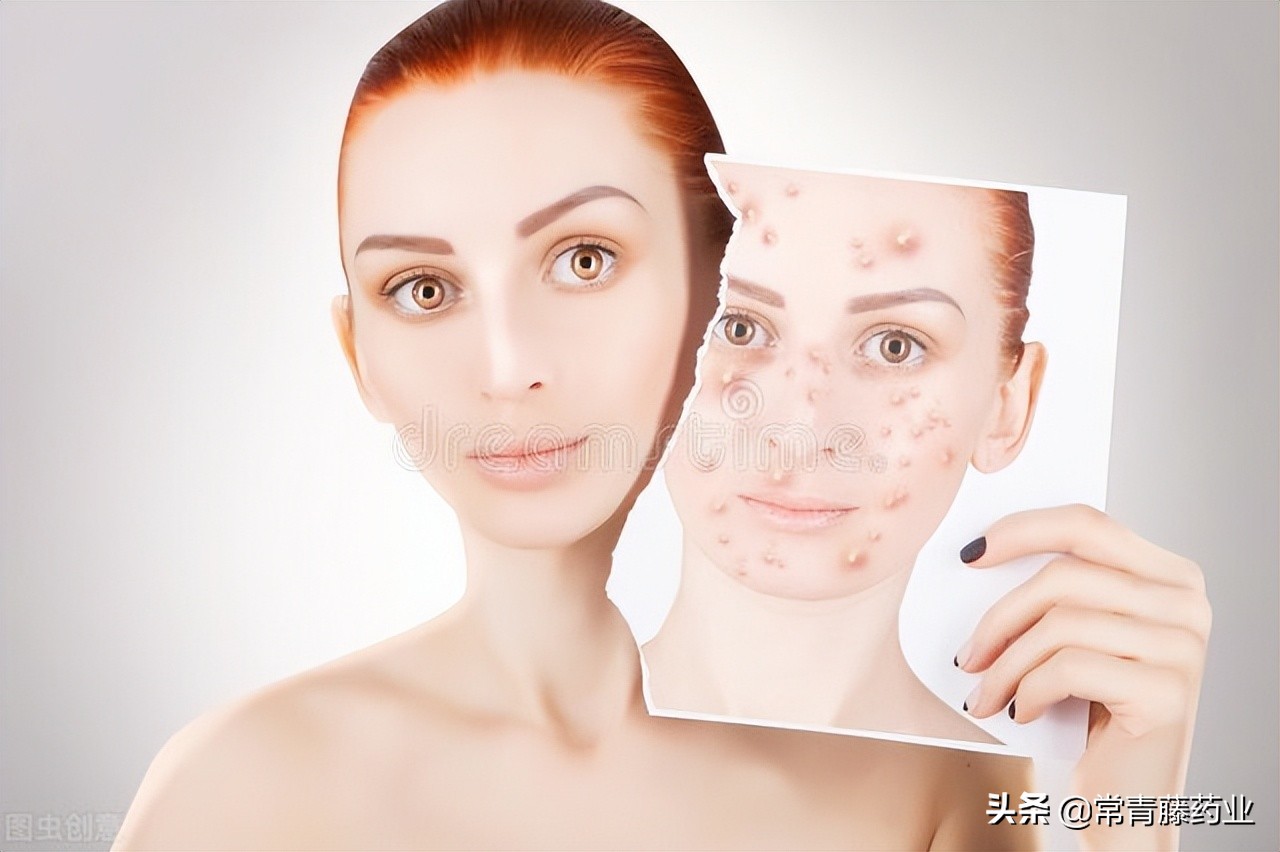 你有痘痘困扰你吗,你有被皮肤问题困扰过吗