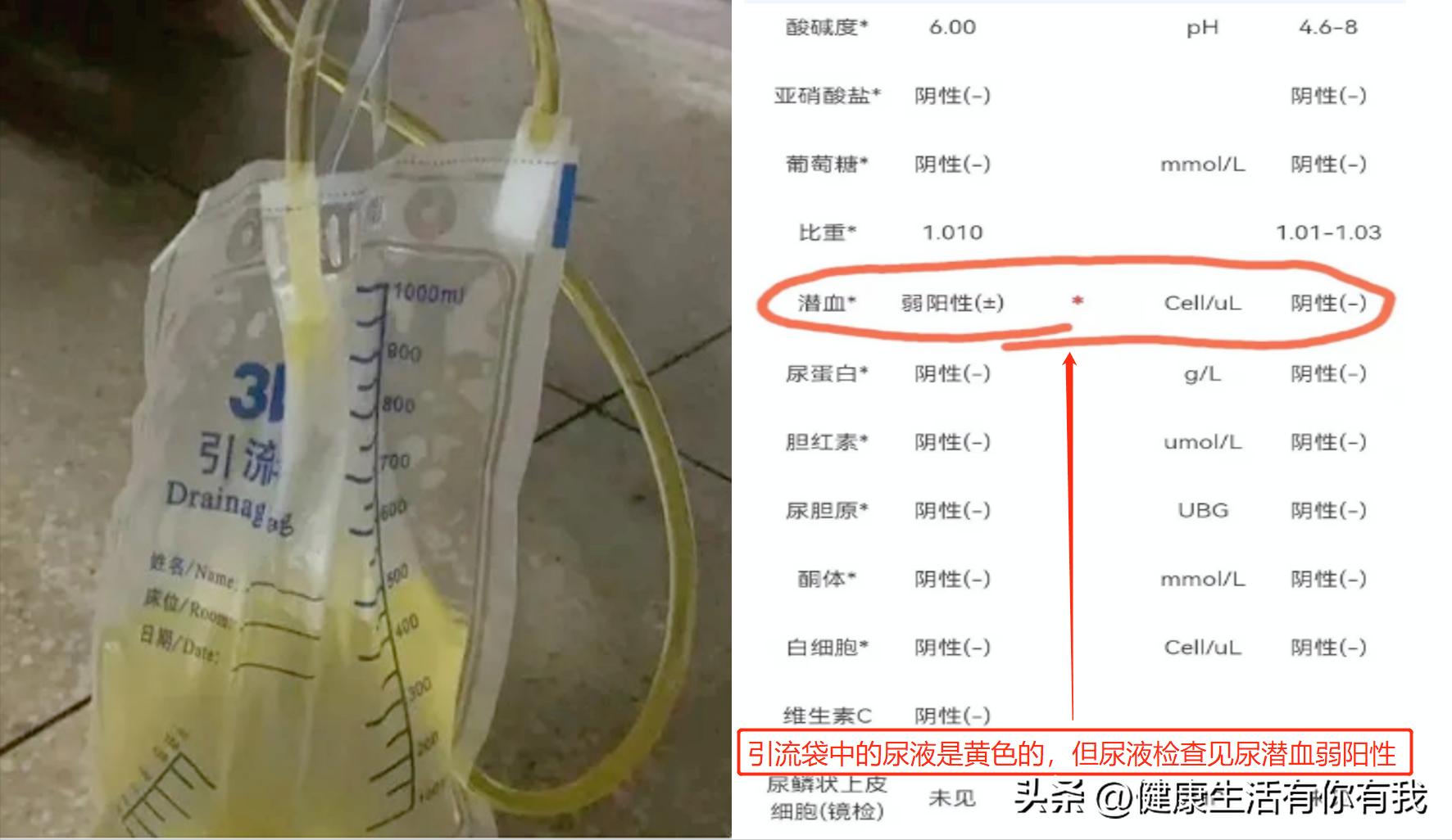 什么是血尿和尿潜血,什么是血尿是怎么回事