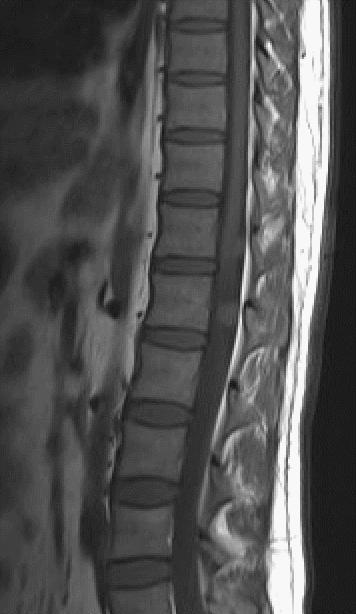 脊柱多发血管瘤手术指征,椎管内良性肿瘤有哪些
