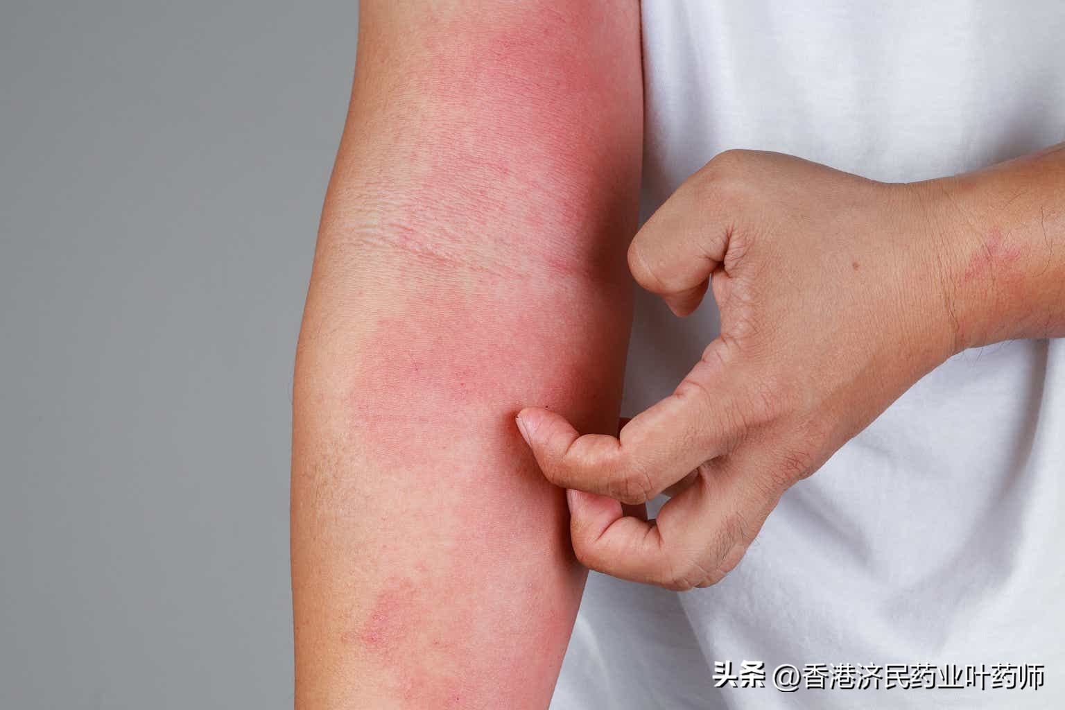 特应性皮炎最新药物研究,最新治疗特应性皮炎口服药进口