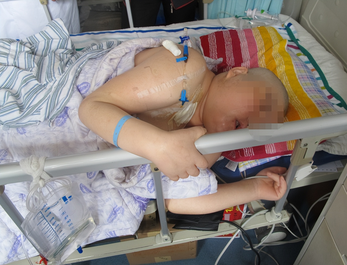 听神经瘤出现脑积水和出血,听神经瘤手术后颅压高症状