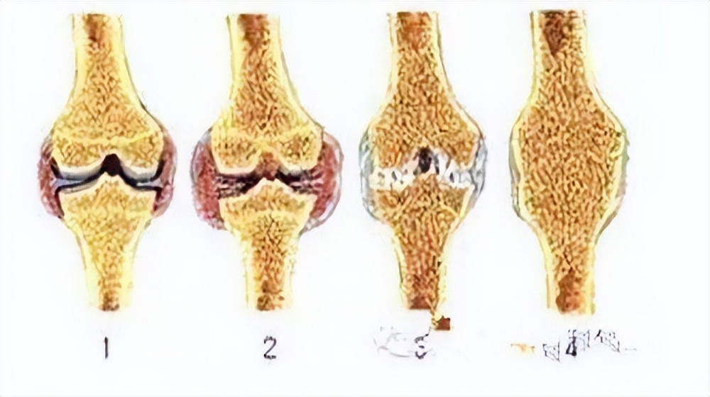 风湿三项正常可以排除强直吗,风湿三项类风湿因子60严重吗