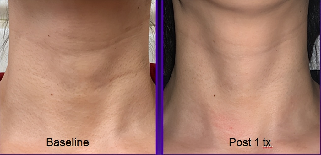 opus超离子祛颈纹维持多久,opus超离子祛颈纹