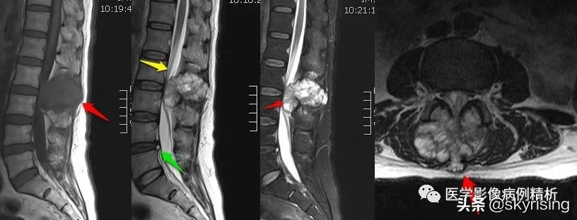 脊索瘤造成骨质破坏严重吗,多发椎体骨质破坏考虑转移瘤
