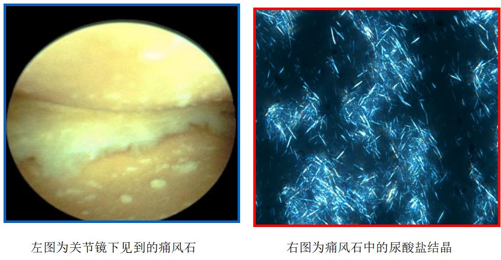 痛风石最简单的解释,世界痛风日是哪一天