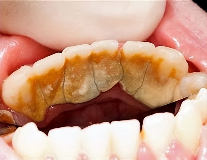 牙缝里的牙结石，如何清除干净？医生：2个办法是不少人的选择