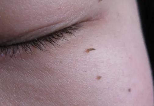 感染hpv之后身上会长什么东西,感染hpv后身上长出纤维瘤