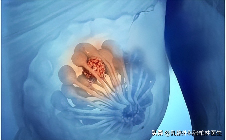 乳房出现这几种胀痛要警惕,乳房胀痛然后有肿块会自愈吗