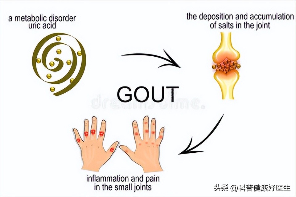 2022全国高尿酸有多少人,全国有多少高尿酸的人