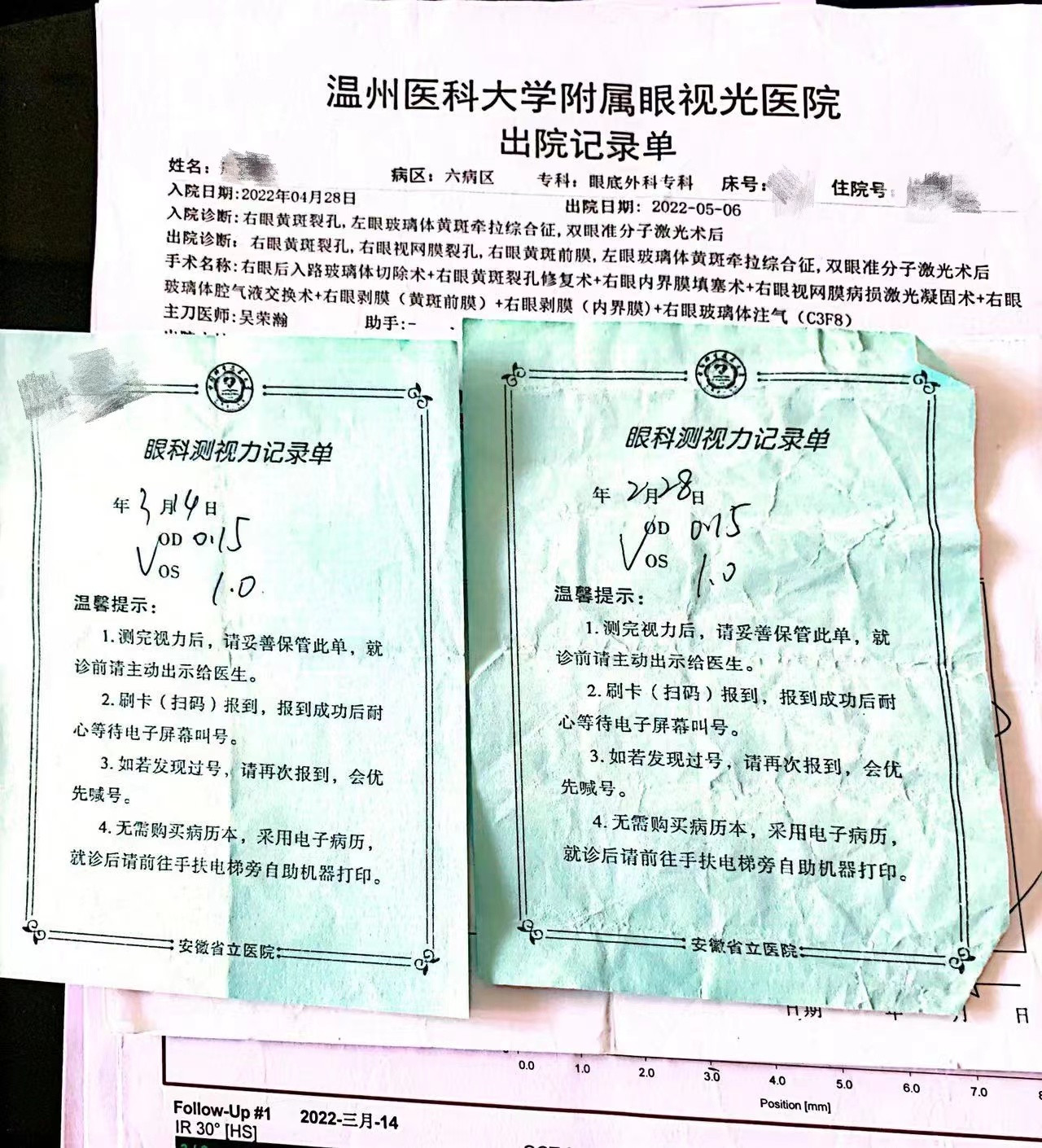 做黄斑裂孔手术是否能引起失明,女子做近视手术后又近视后续