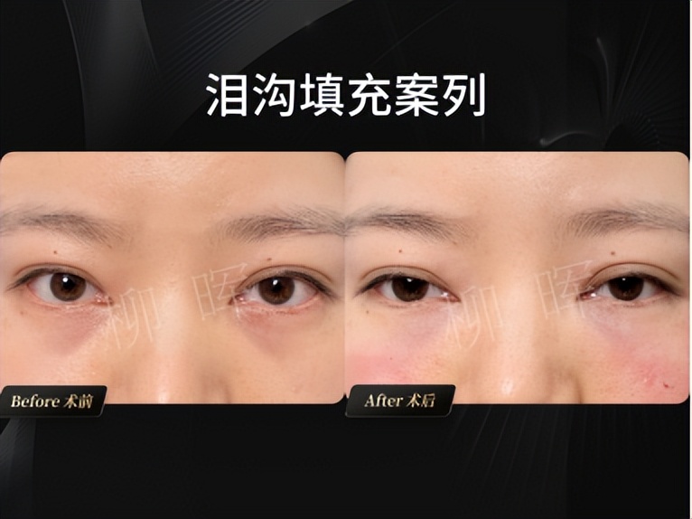 鎵撶幓灏块吀鍙互璧峰埌鎶楄“鐨勪綔鐢ㄥ悧,22宀佹墦浜嗙幓灏块吀