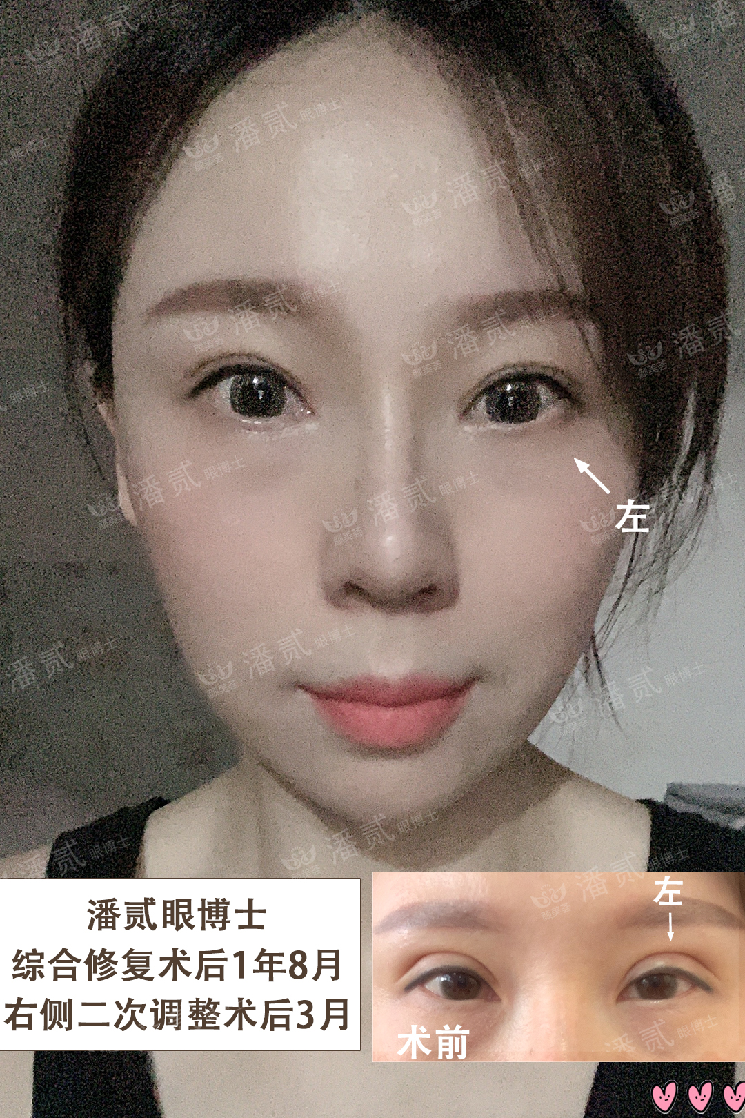 整容失败大眼女,整容12次失败之后长什么样