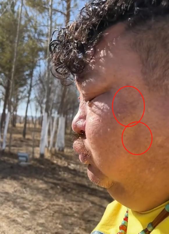 吃播界的“牛亡爷”！恩克面部黑斑扩散，网友：上厕所都成问题