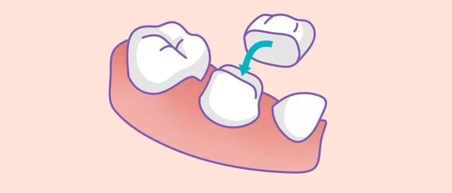 为什么牙医不愿意给我做烤瓷牙套,为什么牙医不想给病人做单冠