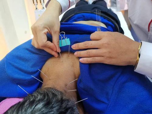 中医解决紧张头痛,中医治疗紧张性头痛