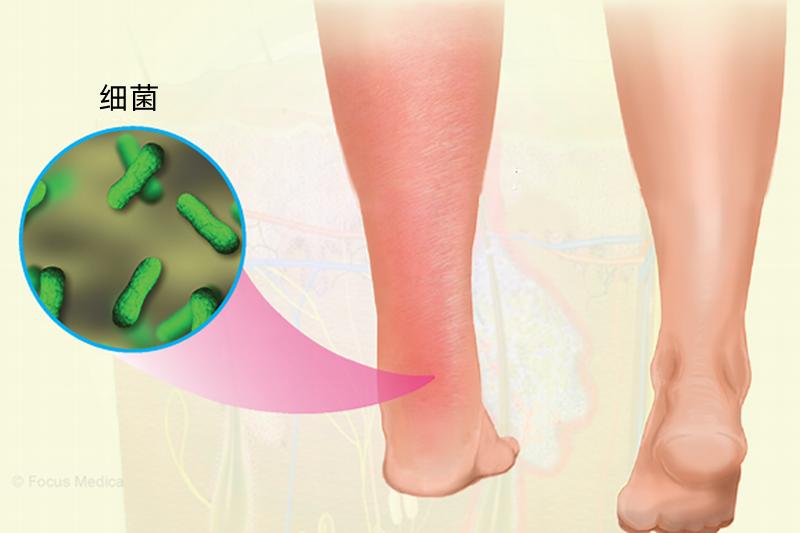 一只脚感觉肿胀是什么原因,一只脚莫名其妙的肿了用什么药