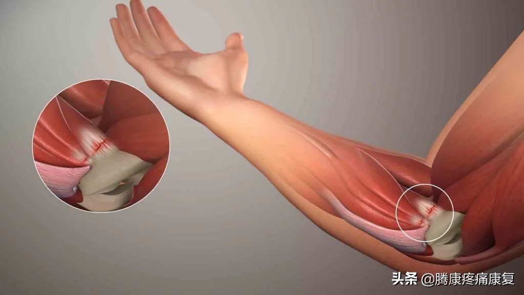 前臂疼痛，这五个动作就能缓解