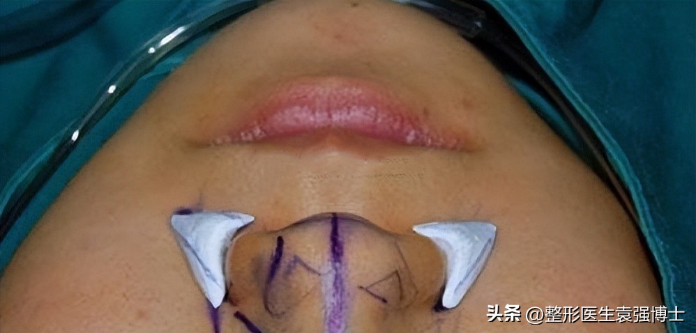 法令纹有什么方法可以去除,法令纹有没有更好的方法去除