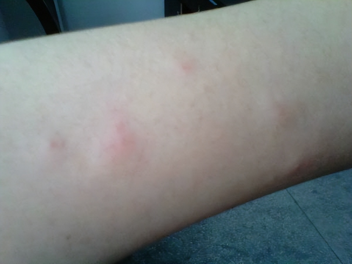 艾滋病皮肤病与其它皮肤有何区别,艾滋病跟乙肝一样吗