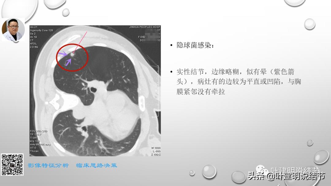 在《一脉阳光》呼吸影像诊断专题培训班上的讲课PPT（第一部分）