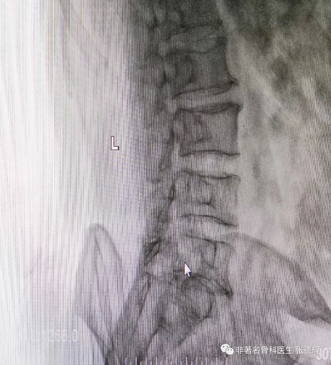 腰椎峡部裂的最好治疗方法,腰椎峡部裂