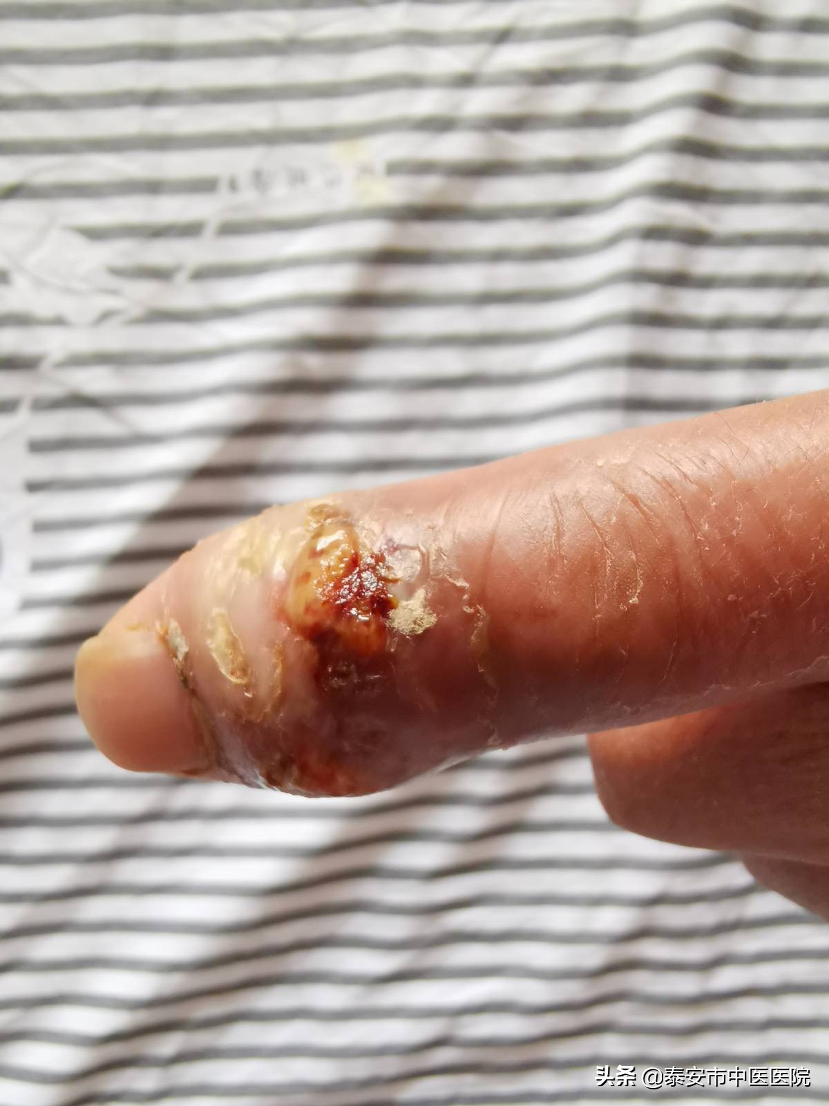 微创技术治疗疼痛,微创手术除病痛