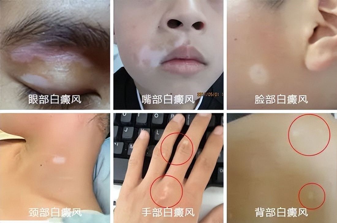 他克莫司怎么这么多副作用,他克莫司不要轻易用