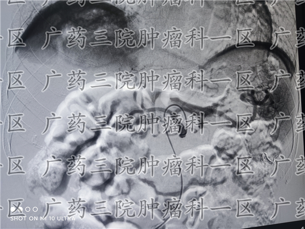 胃癌手术后转肝癌后怎么治愈,胃癌切除后又出现肝癌