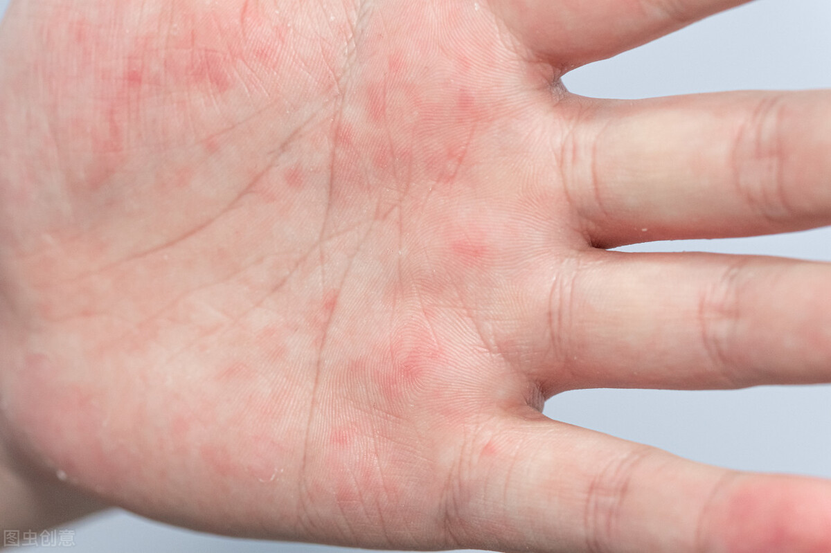 汗疱疹特别痒的时候怎么办,为什么汗疱疹反复发作呢怎么治疗