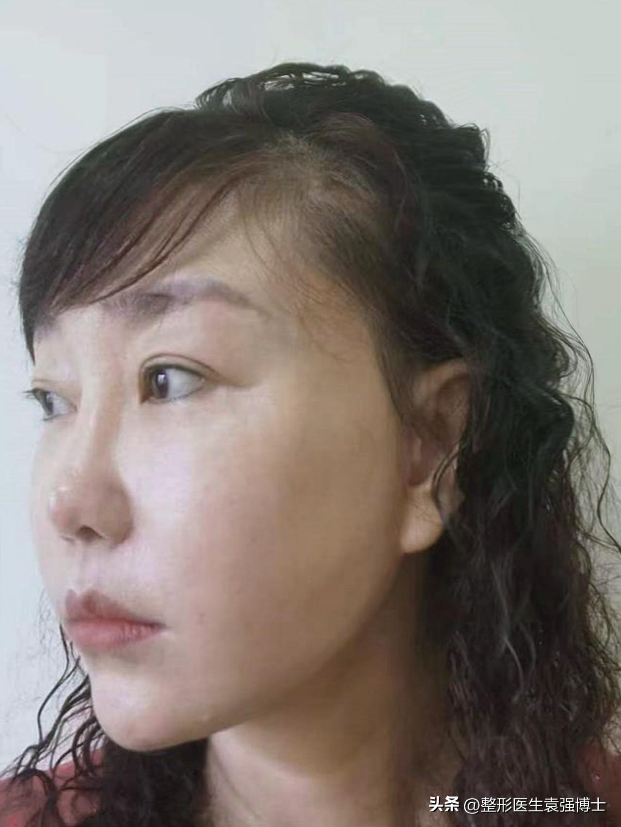 来北京做大拉皮2个月，脸小一圈，法令纹减轻，切口恢复成这样