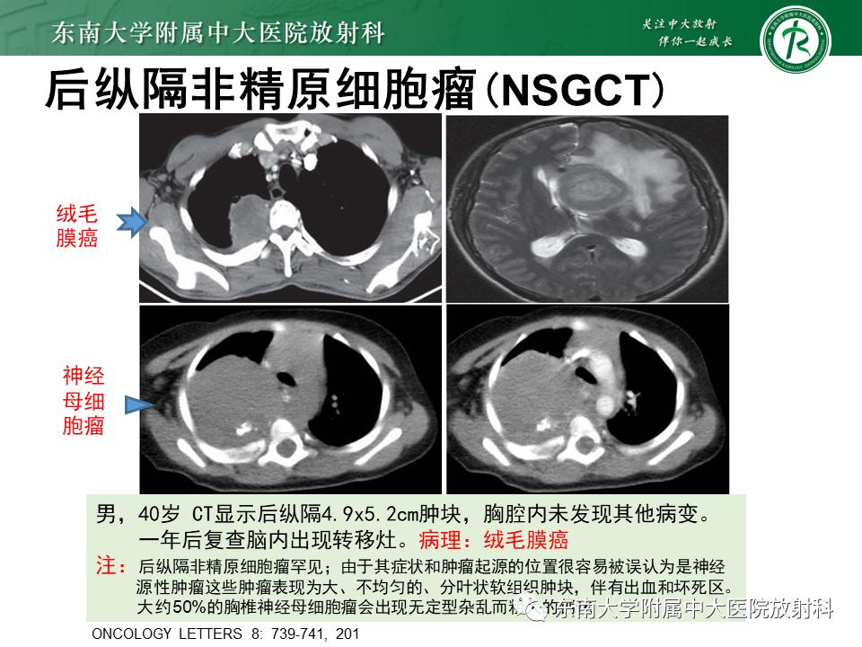 好文分享值得深思,纵隔精原细胞瘤