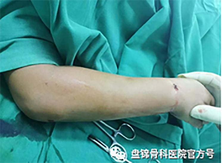 中医怎么处理小儿桡骨骨头骨折,治疗尺桡骨骨折的方法及步骤