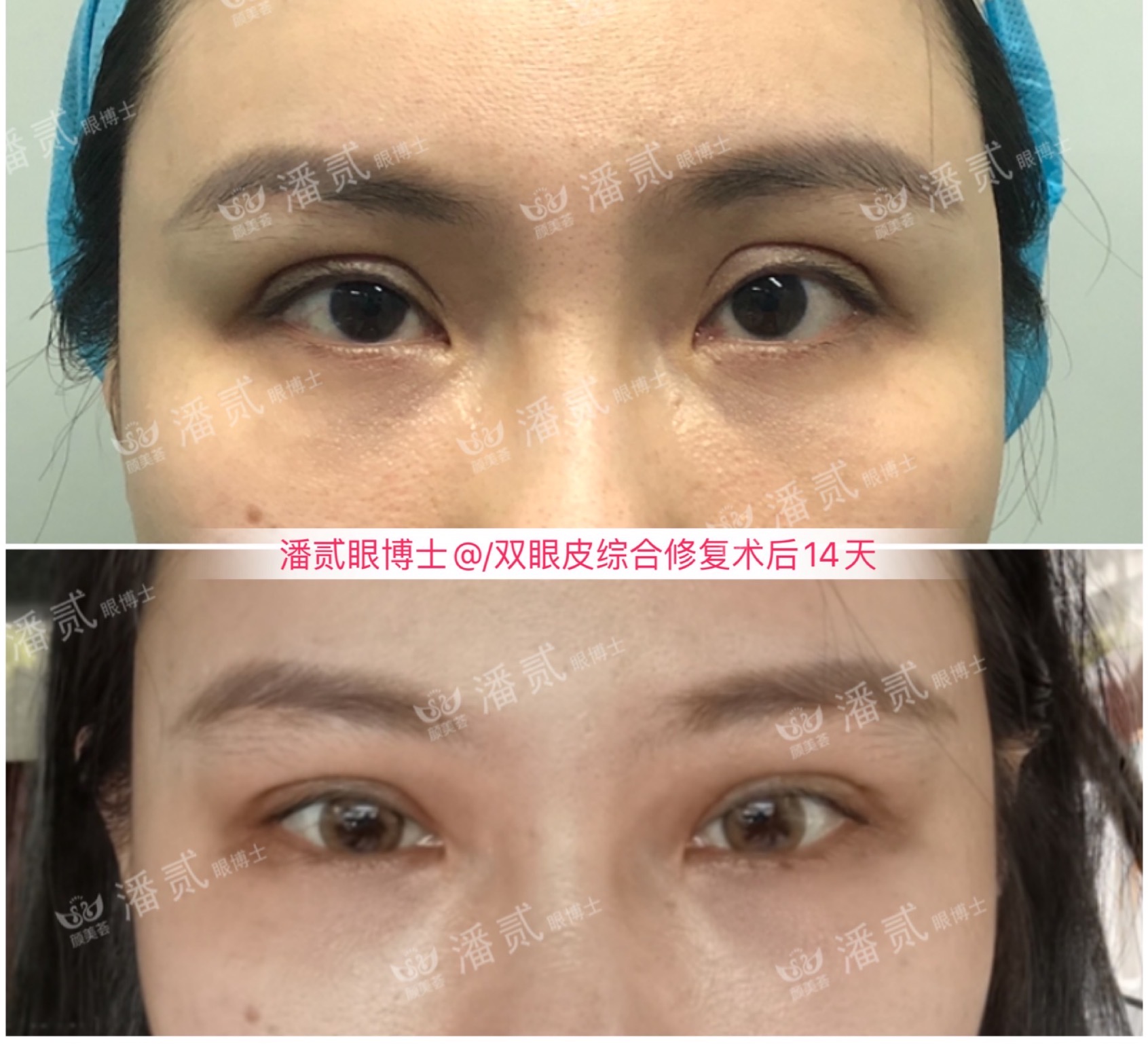 千万别被网红宽双眼皮*脑洗**了，对眉骨高眼窝深邃的人可能是灾难