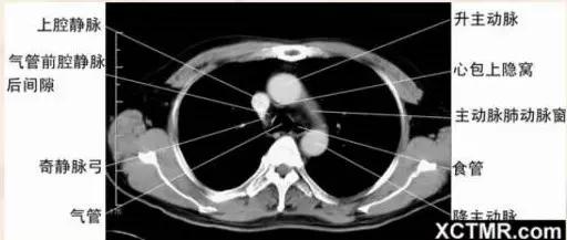 胸腹部盆腔ct主要检查什么,女性盆腔ct断层解剖结构图