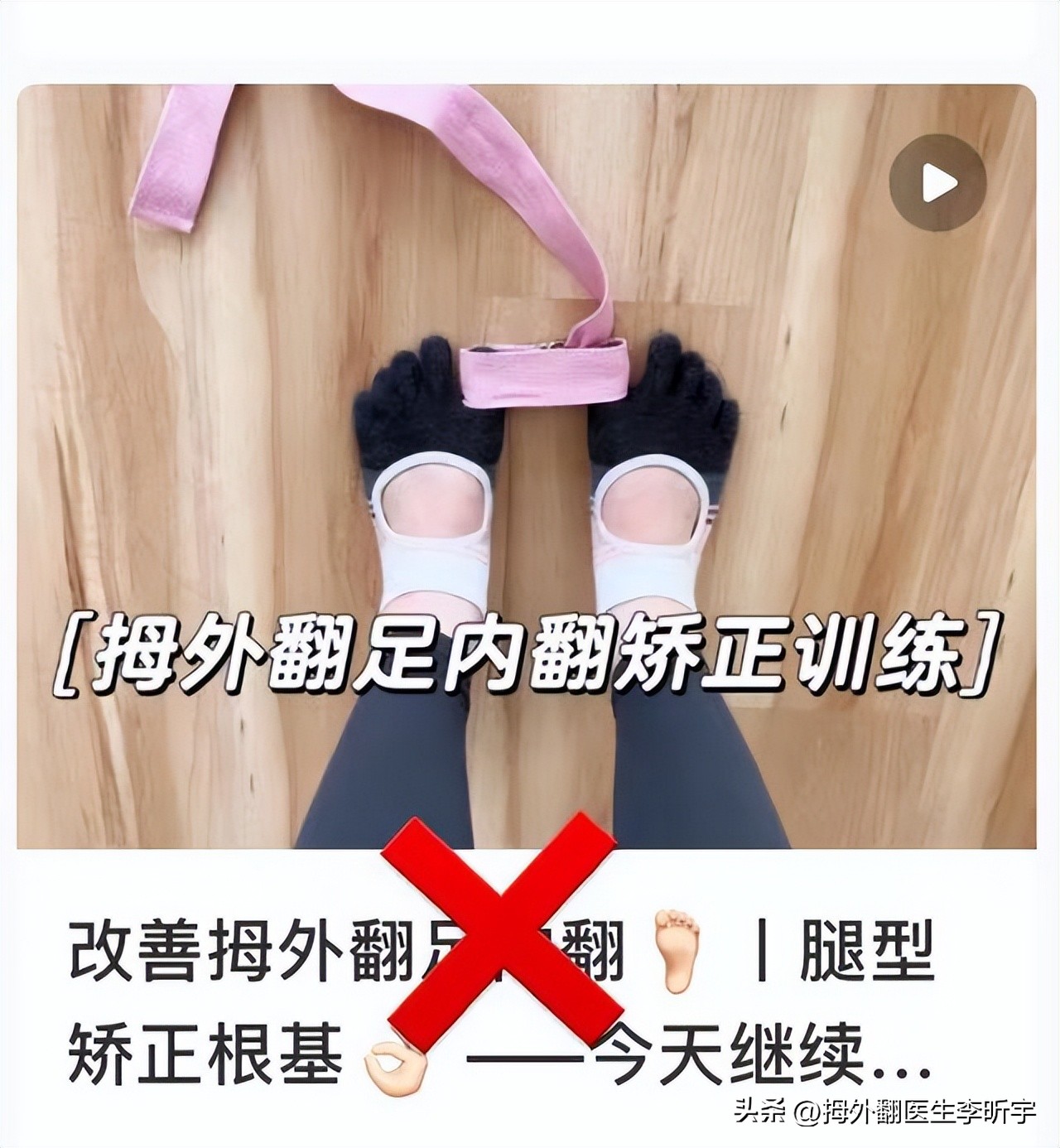 拇外翻矫正器真的有用吗,拇指外翻矫正器是智商税吗