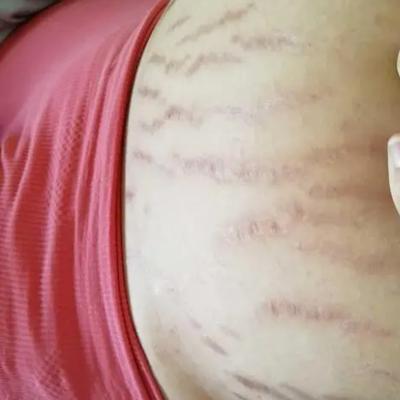 未婚未育肚子上有妊娠纹,男子发现未婚妻妊娠纹