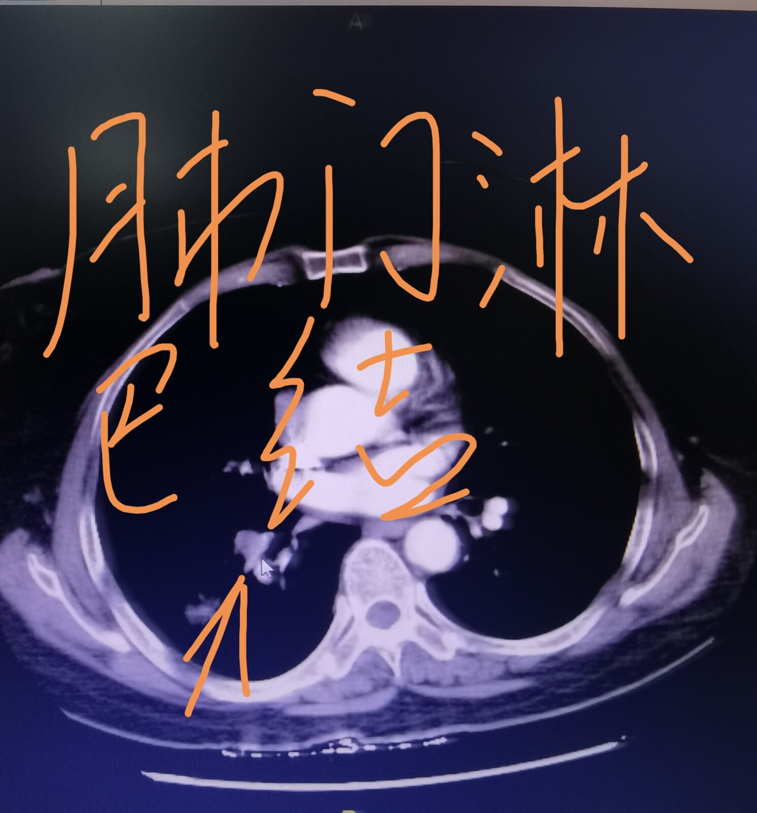 刘懿博士说肺癌,刘懿博士谈肺癌脑转移