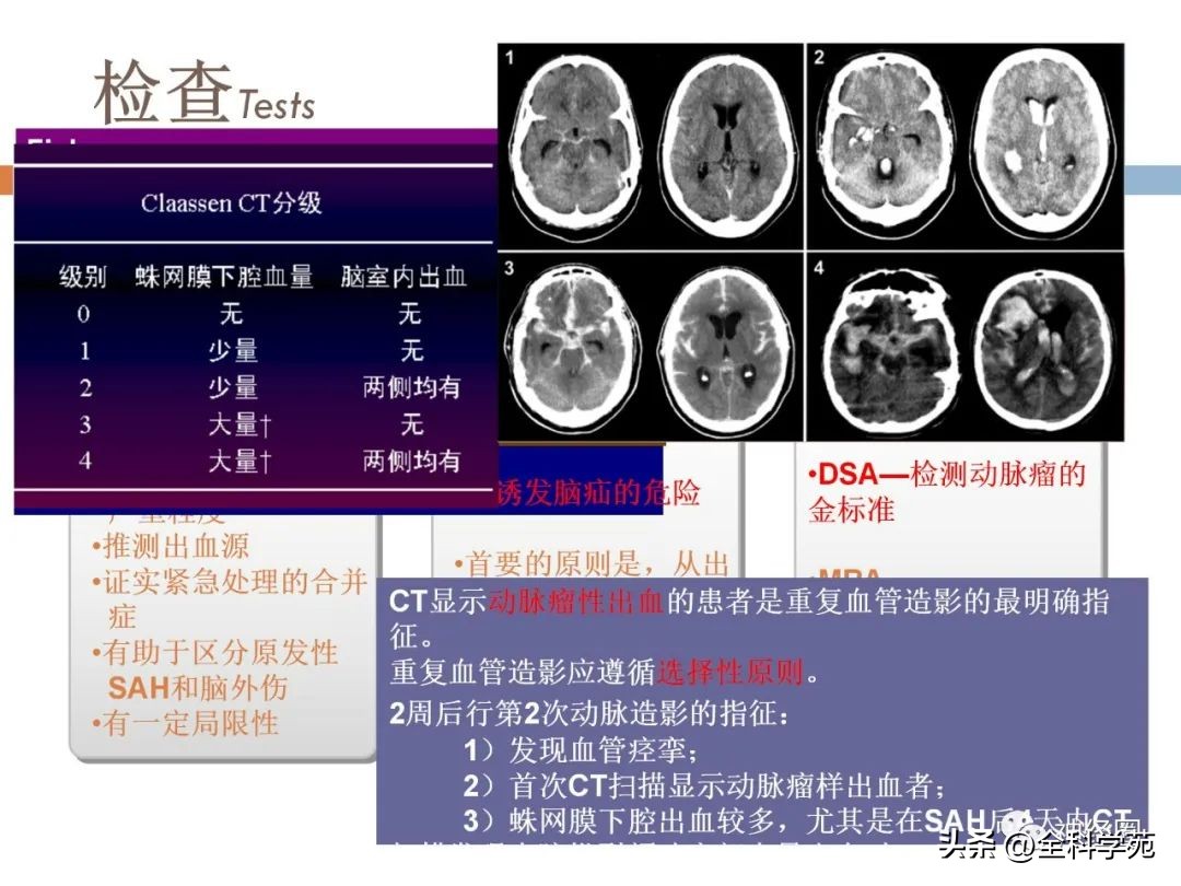 蛛网膜下腔出血属于脑卒中吗,头部蛛网膜下腔出血怎么治疗