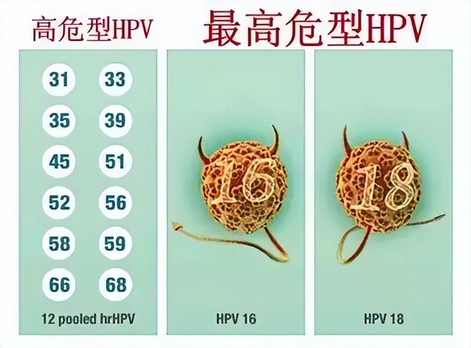 从hpv感染到宫颈癌要经历哪些过程,hpv导致宫颈癌的比例有多少