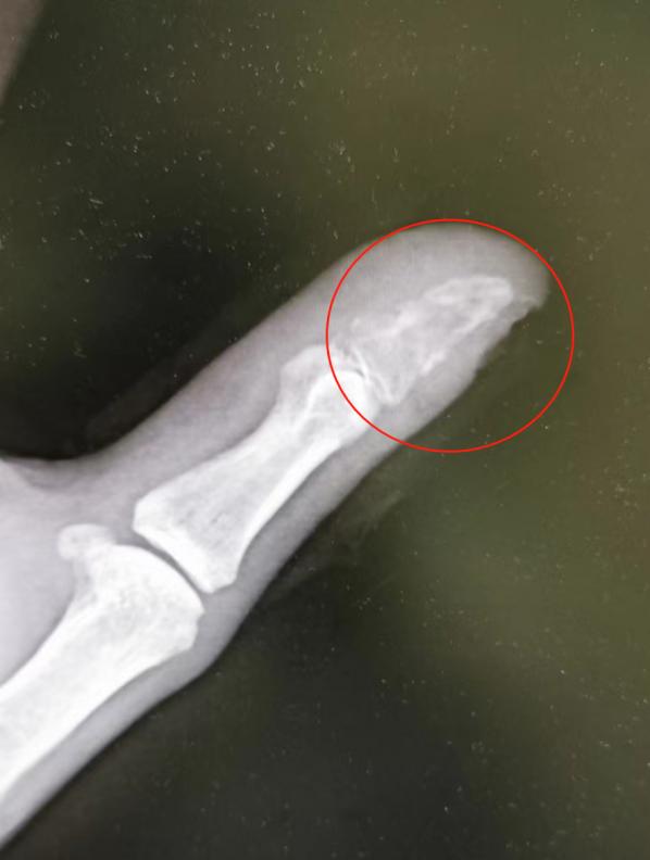 大拇指被小狗咬了一个口出血了,男子拇指被咬伤后险截指