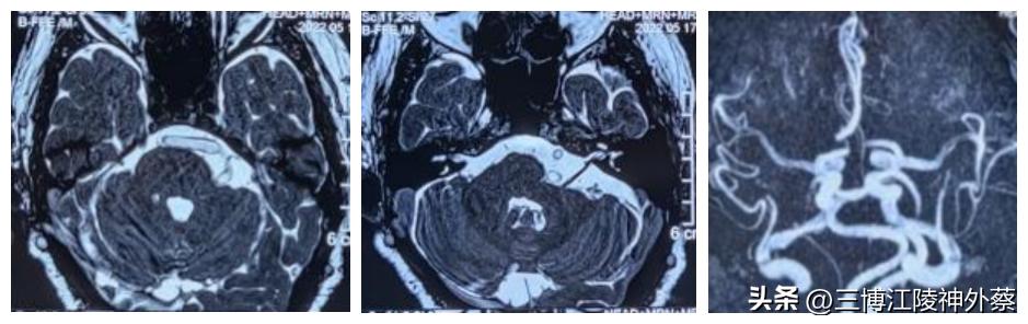 双侧面肌痉挛真实案例,面肌痉挛会发展成三叉神经痛吗