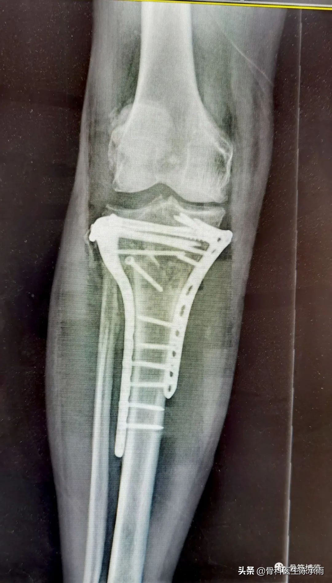 陈旧性腿骨骨折,陈旧性骨折