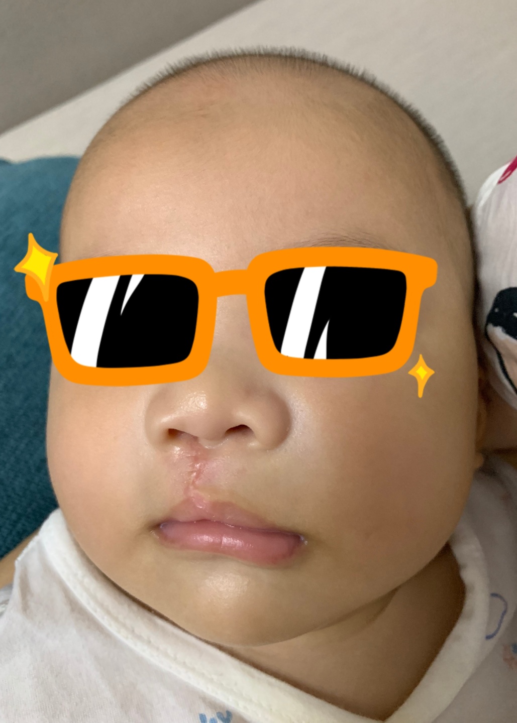 宝宝是一只“小兔子”，还没长牙就要开始正畸了