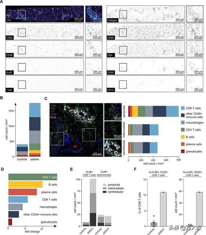 德国儿童肝炎,欧美爆发肝炎