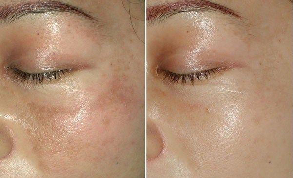 肝郁症状面部有黑斑,肝郁气滞黧黑斑