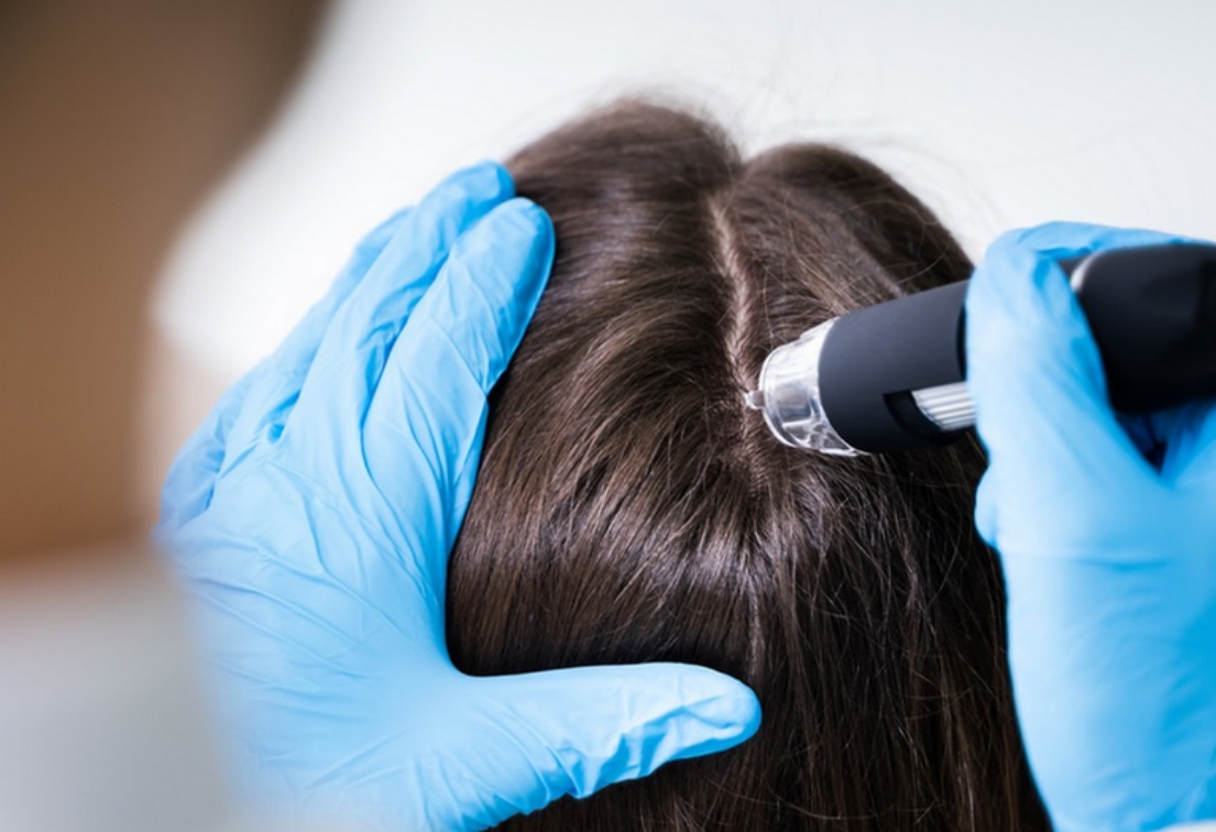 怎么脱发最有效果,怎么样脱发才算严重