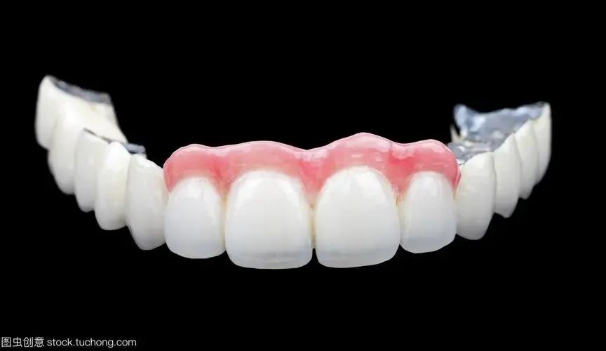 烤瓷牙一定要做桩吗,烤瓷牙用哪种牙套好