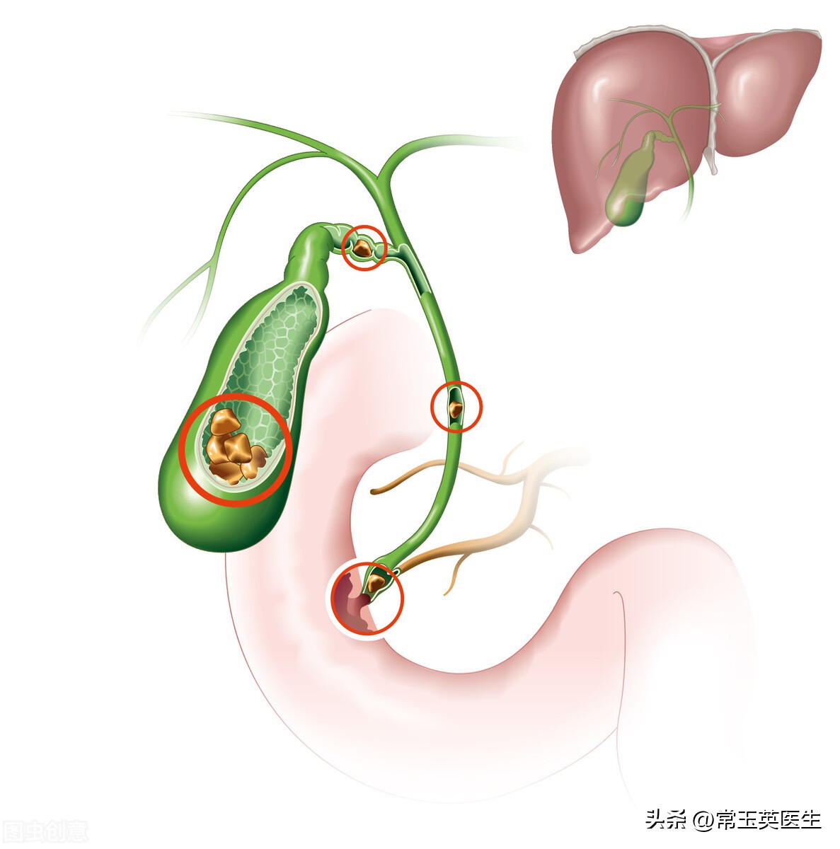 胆总管末端结石怎样处理才好,肝胆总管结石症状与危害