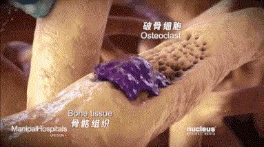 跳绳导致胸椎压缩性骨折,跳绳跳到肋骨脱臼