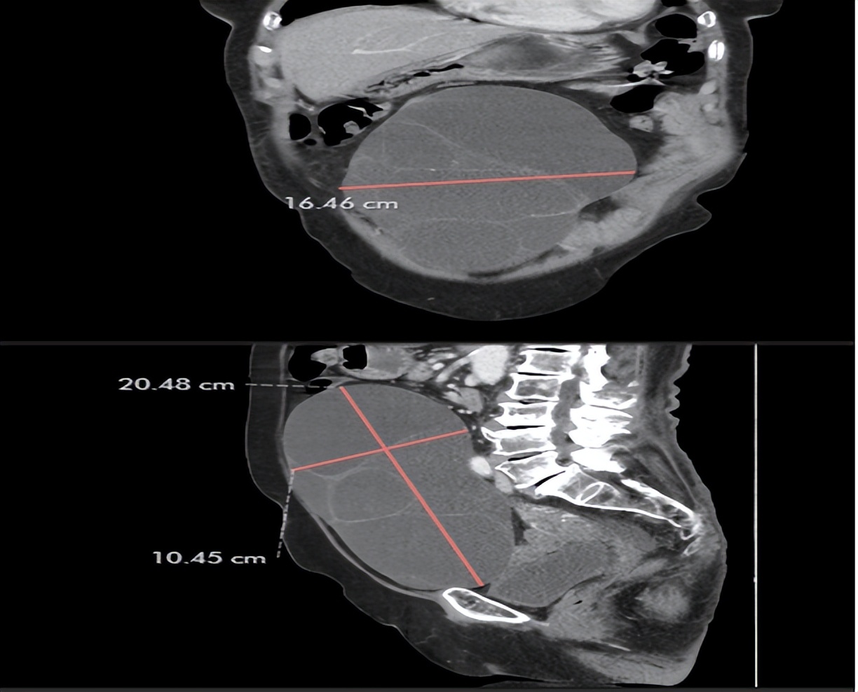 南京市鼓楼医院援圭亚那医生单孔腹腔镜下成功摘除老年巨大卵巢囊肿